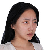 美莱案例陈嘉歆术前45°