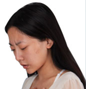 美莱案例陈嘉歆术前90°