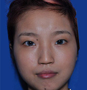 美莱案例黄思斓术前0°