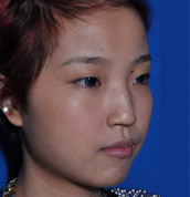 美莱案例黄思斓术前45°