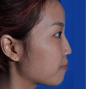 美莱案例黄思斓术前90°