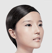 美莱案例黄思斓术后45°