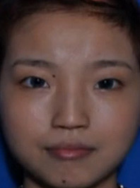 美莱案例黄思斓术前