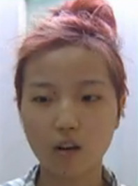 美莱案例黄思斓手术当天