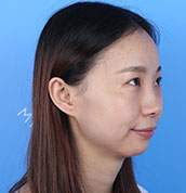 美莱案例孟梦术前45°