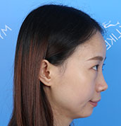 美莱案例孟梦术前90°