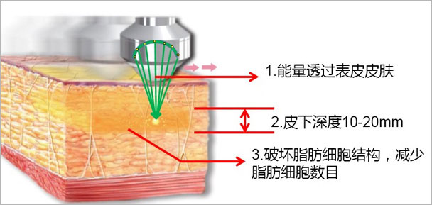 聚焦吸脂减肥