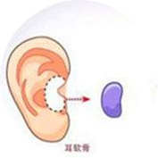 取软骨雕刻成型