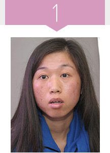 美莱祛斑治疗前色斑严重