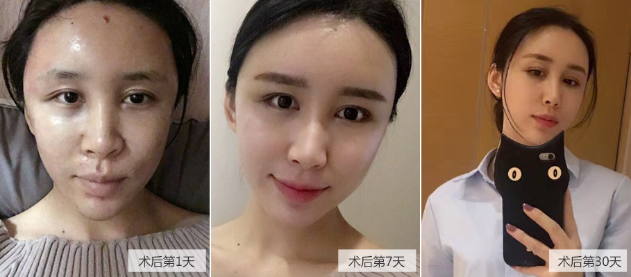 上海美莱术后