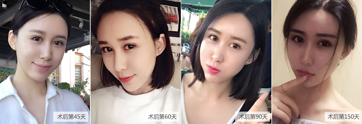 上海美莱术后