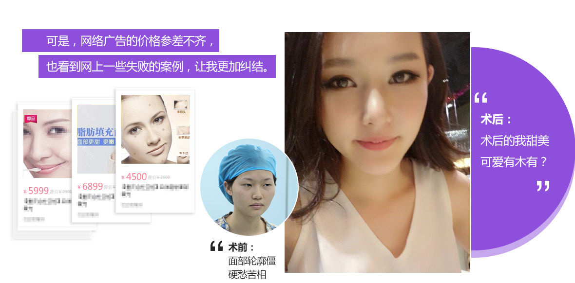 上海美莱自体填充效果