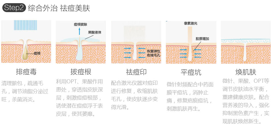 内调外治 综合祛痘