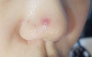 鼻翼痘