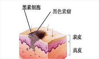 脸上的黑痣发生病变