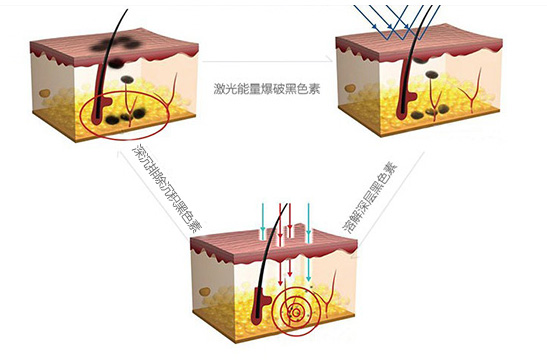 美莱激光祛痣原理