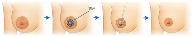 上海胸部整形医院