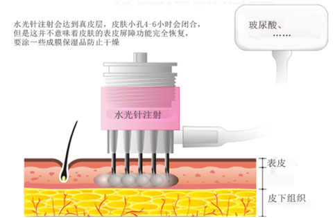 水光注射