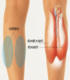 美莱瘦腿针注射后曲线柔和