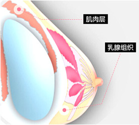 美莱胸部整形四大技术特点