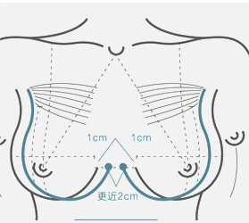 美莱胸部整形四大技术特点