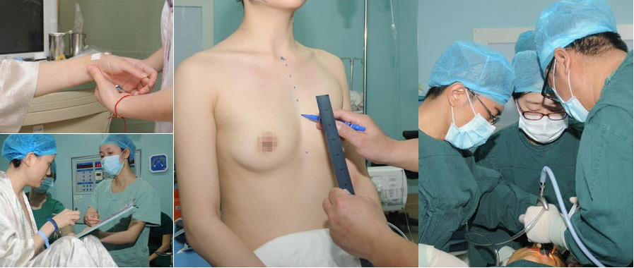 美莱胸部整形术中专业操作