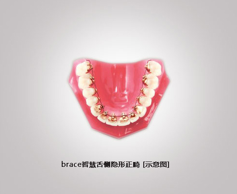 brace智慧舌侧隐形正畸