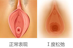 阴道Ⅰ度松弛的表现症状