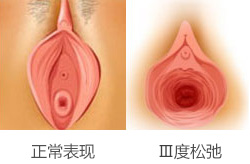 阴道Ⅲ度松弛的表现症状