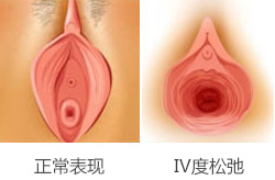 阴道Ⅳ度松弛的表现症状