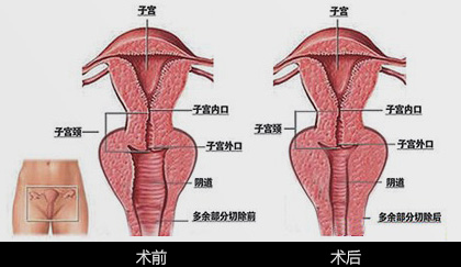 美莱韩式微创阴道紧缩术