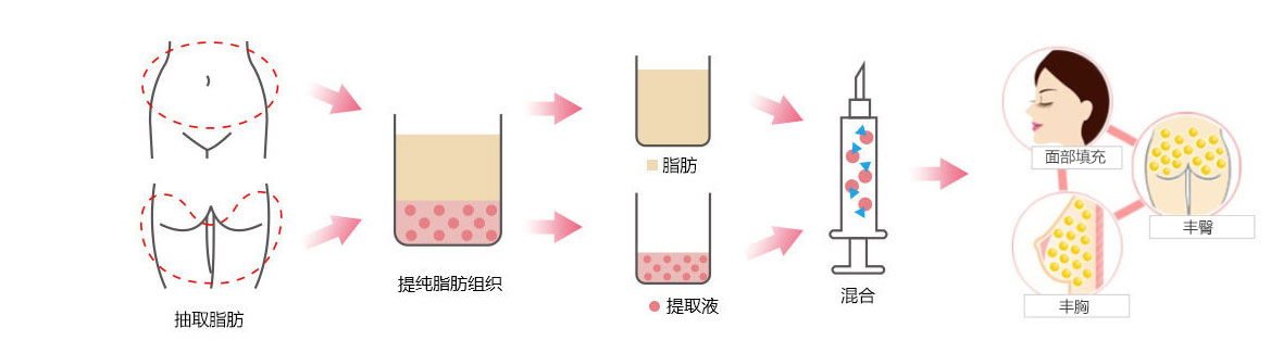 自体活细胞移植过程