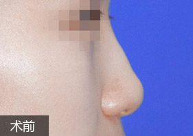 综合隆鼻案例