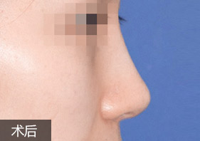 综合隆鼻案例