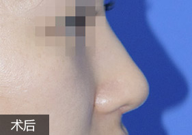 经典假体隆鼻案例