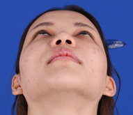 美莱隆鼻案例欧阳莹莹术前照片