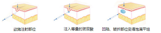 玻尿酸除皱注射过程