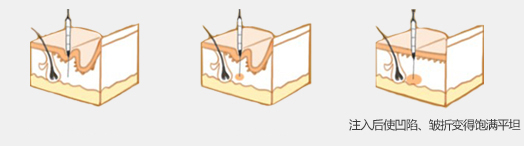 美莱除皱针注射过程